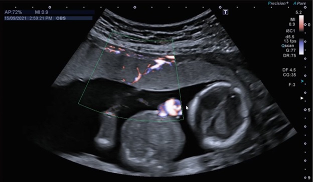 Ultrasound image of shared placenta
