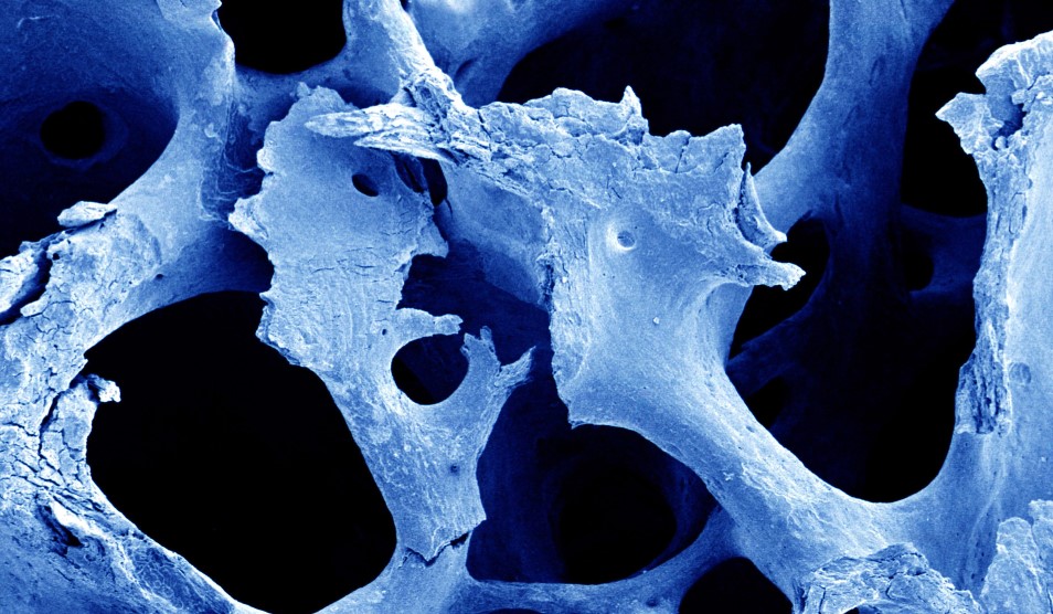 Scanning electron micrograph of osteoporotic bone, computer-coloured blue.