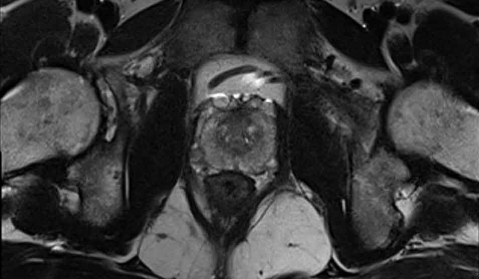 Prostate MRI image