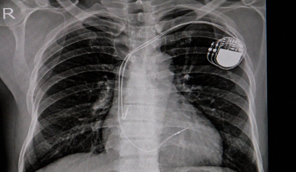 AI can improve X-ray identification of pacemakers in emergencies Photos and graphics subject to third party copyright used with permission or © Imperial College London.