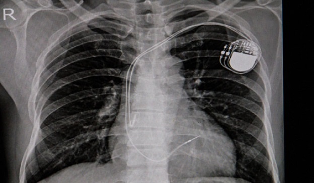 Ai Can Improve Xray Identification Of Pacemakers In
