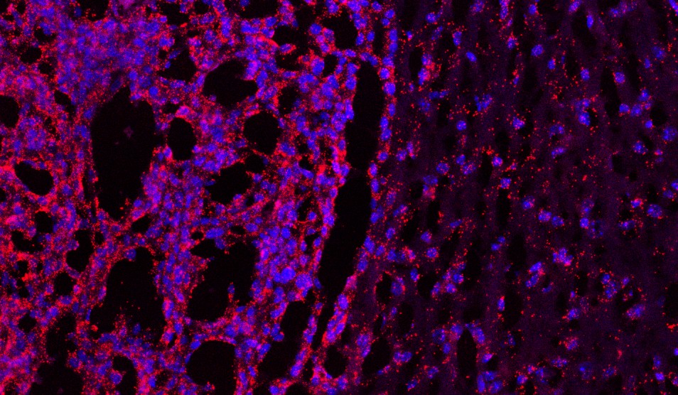 Glioblastoma Multiforme (GBM)