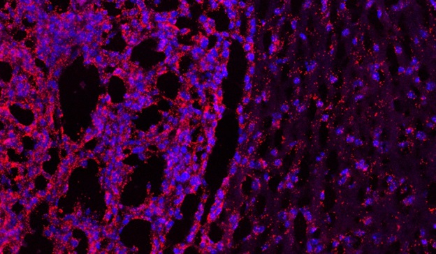 Glioblastoma Multiforme (GBM) - Imperial College London credit Glioblastoma Multiforme (GBM)