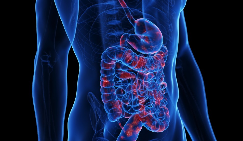 A scan of the body illustrating ulcerative colitis