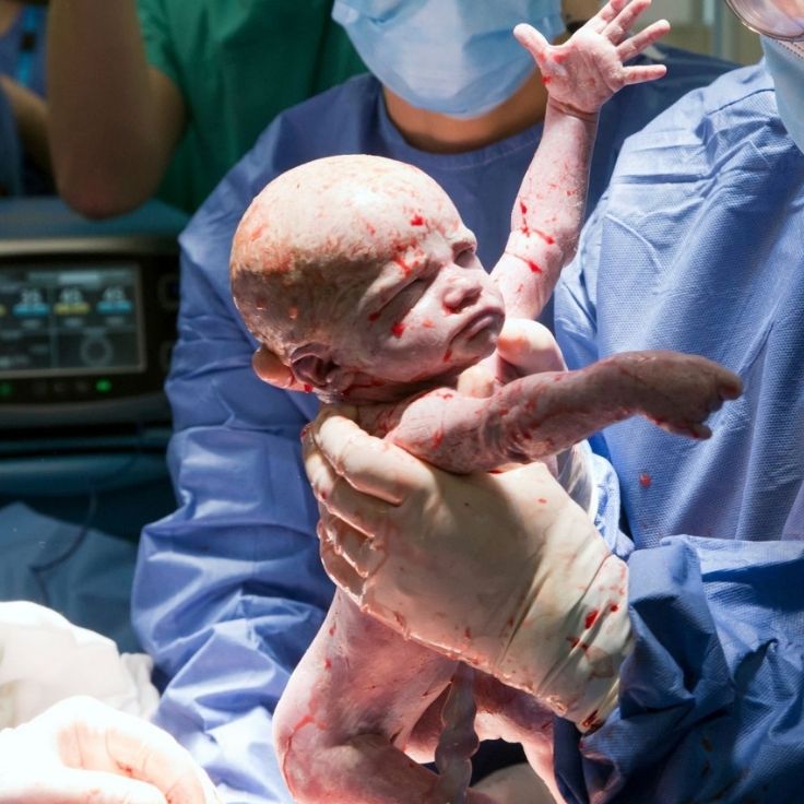 First baby born of womb transplant