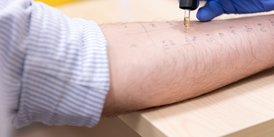 Person being tested for allergies Person being tested for allergies