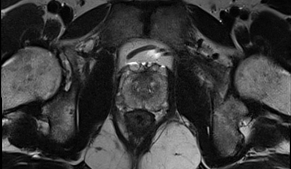 Innovative scan for prostate cancer could save lives by increasing early detection